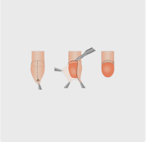 Diagram van besnijdenis